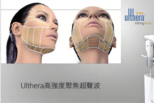 ulthera超声刀.jpg ulthera超声刀.jpg