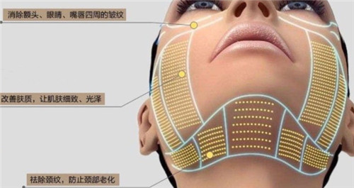 热玛吉皮肤作用细节图.jpg 热玛吉皮肤作用细节图.jpg