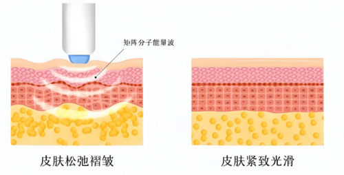 热玛吉作用对比.jpg 热玛吉作用对比.jpg