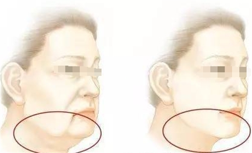 微拉美面部提升动画前后对比图.png 微拉美面部提升动画前后对比图.png
