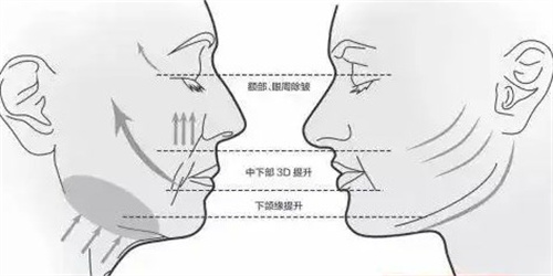面部提升三大部位.jpg 面部提升三大部位.jpg