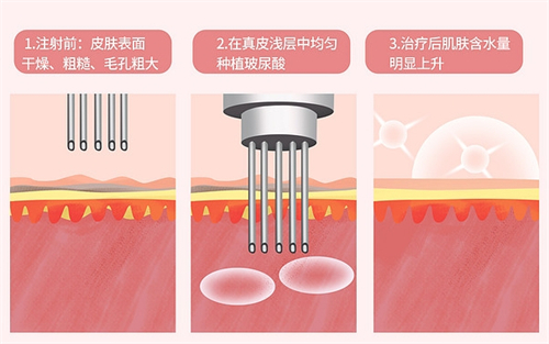 水光前后皮肤对比.jpg