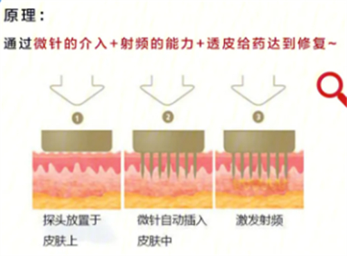 黄金微针原理分析.jpg