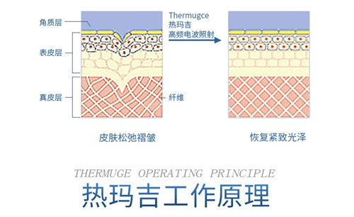 热玛吉工作示意图.jpg 热玛吉工作示意图.jpg
