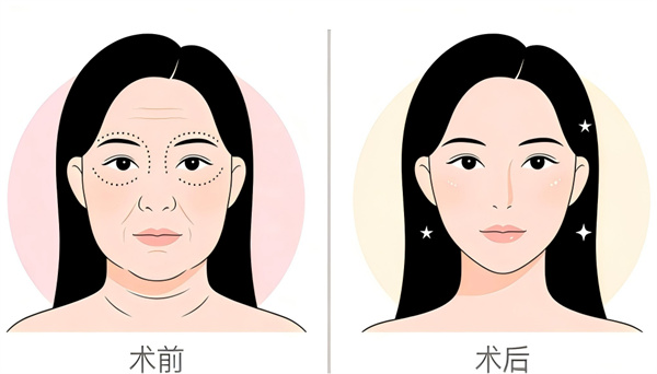 面部紧致提升手术前后对比.jpg 面部紧致提升手术前后对比.jpg